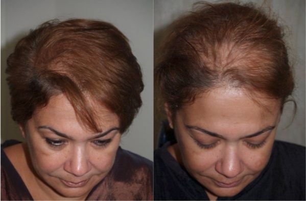 نتائج وصور زراعة الشعر للنساء قبل وبعد