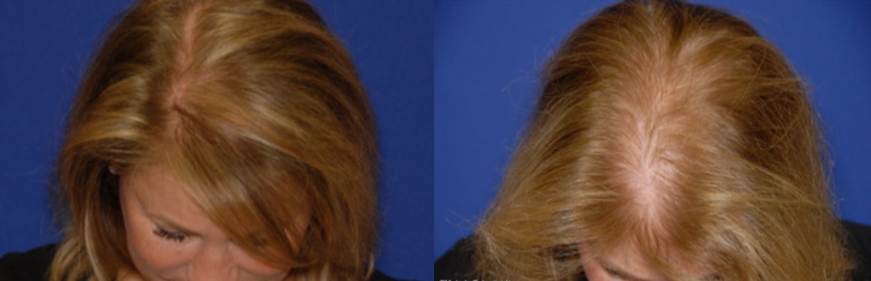 صور زراعة الشعر للنساء قبل وبعد