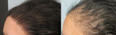 نتائج وصور زراعة الشعر للنساء قبل وبعد (2)