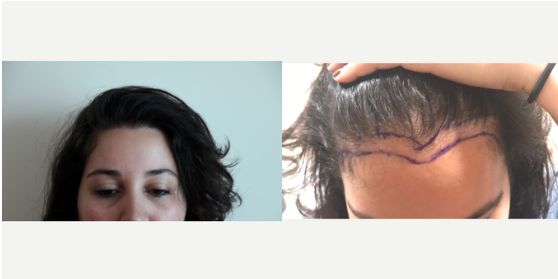  زراعة الشعر تجارب النساء (2)