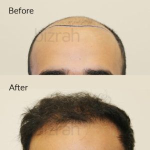 عملية زراعة الشعر قبل وبعد في مركز بزرة ميد