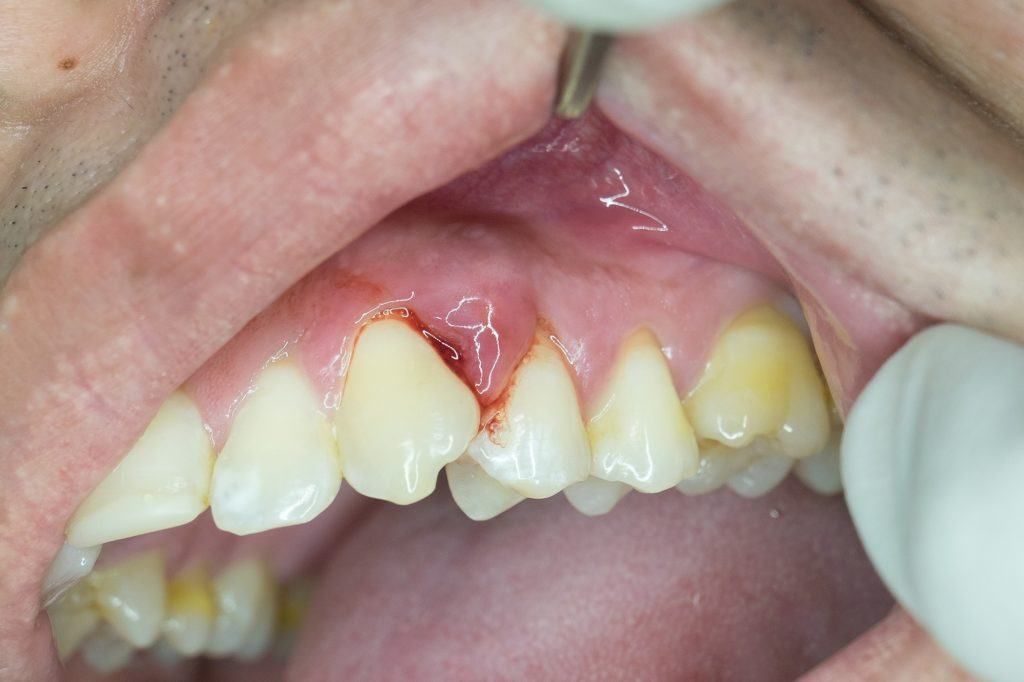 مشاكل طقم الأسنان المتحرك