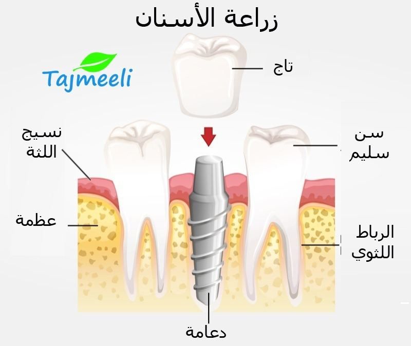 نبذة عن زراعة الأسنان بدون جراحة في الرياض
