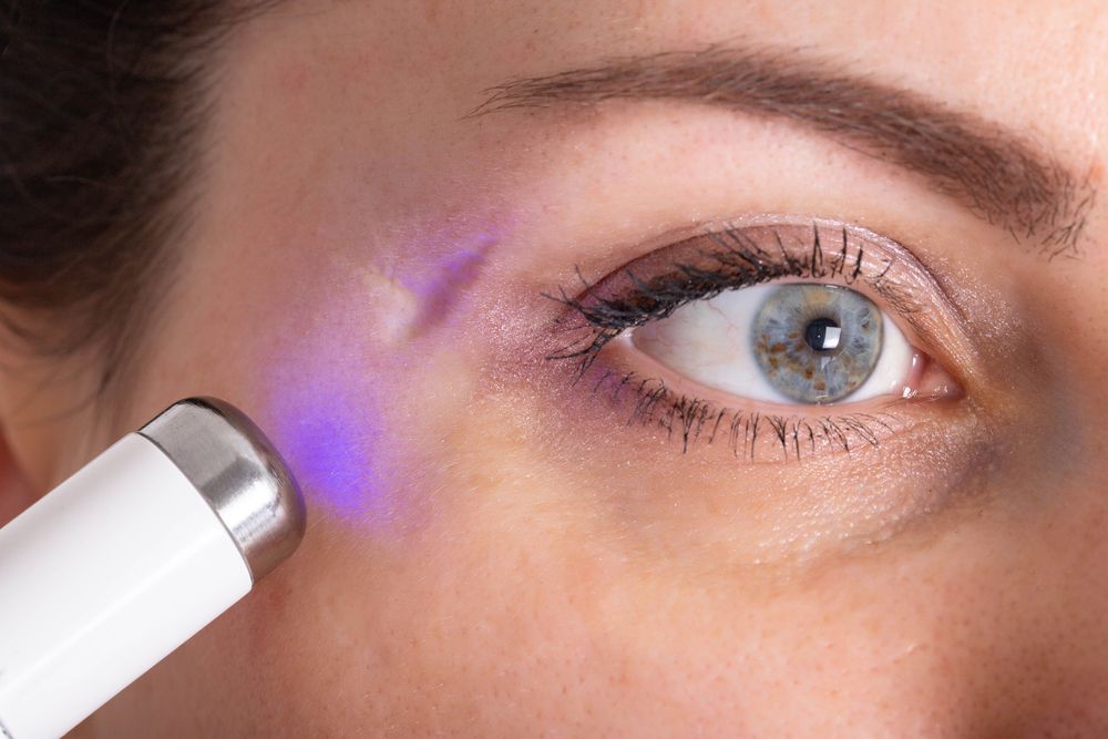 خطوات عملية الليزر لعلاج الندوب في الوجه