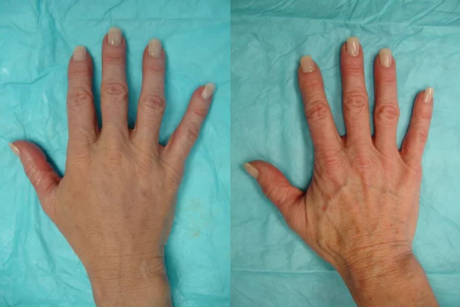 استخدام الليزر لعلاج تجاعيد اليدين