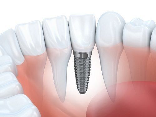 بعض المصطلحات الطبية المتعلقة بزراعة الأسنان 