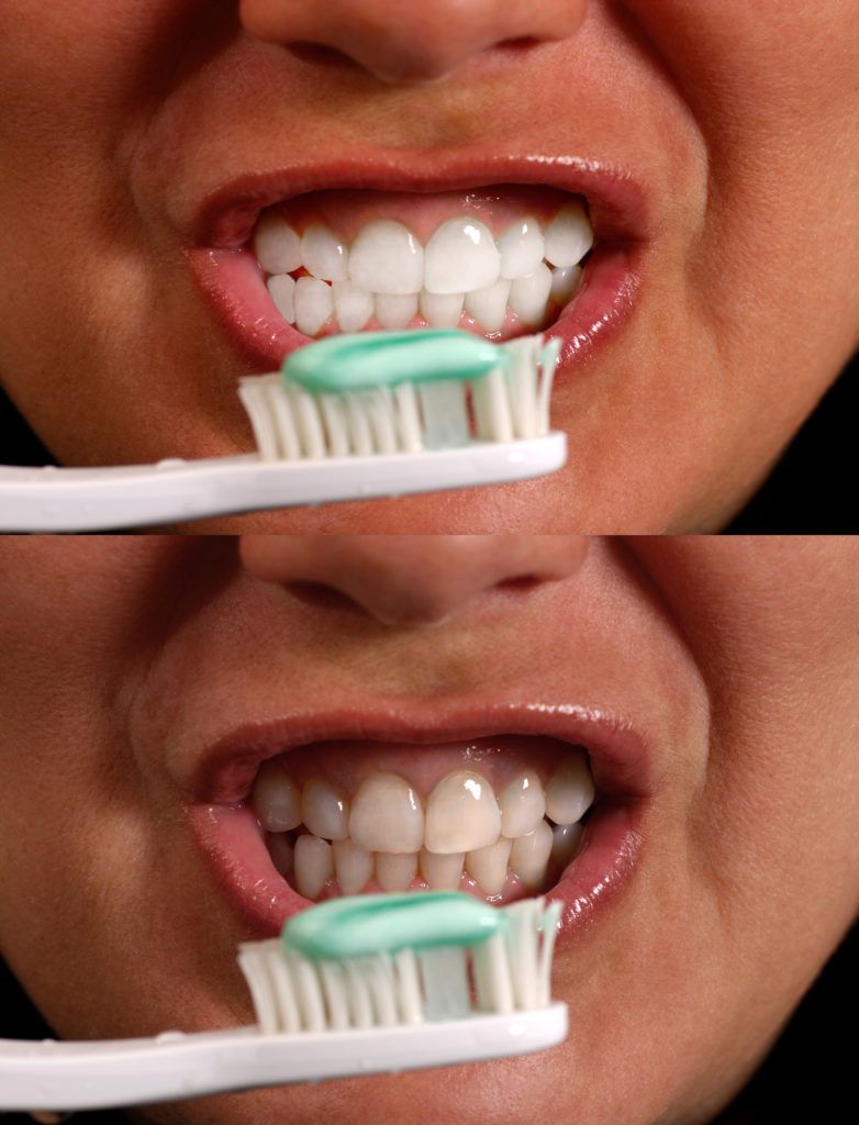 طرق العناية بالأسنان بعد جلسات التبييض بالليزر