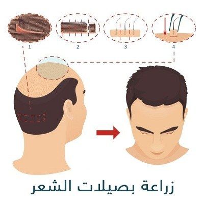 تجارب زراعة الشعر في دبي
