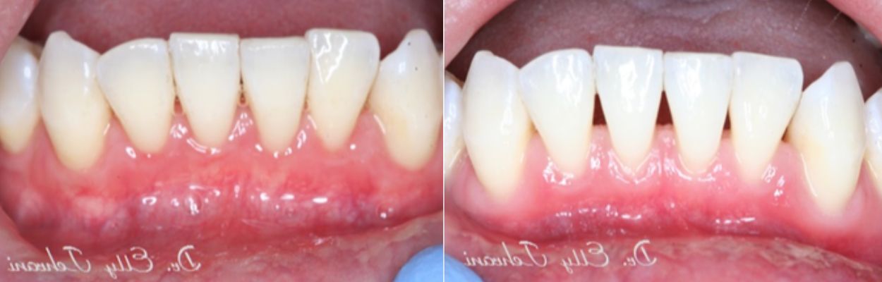 انحسار اللثة عن الأسنان الأمامية التحتية