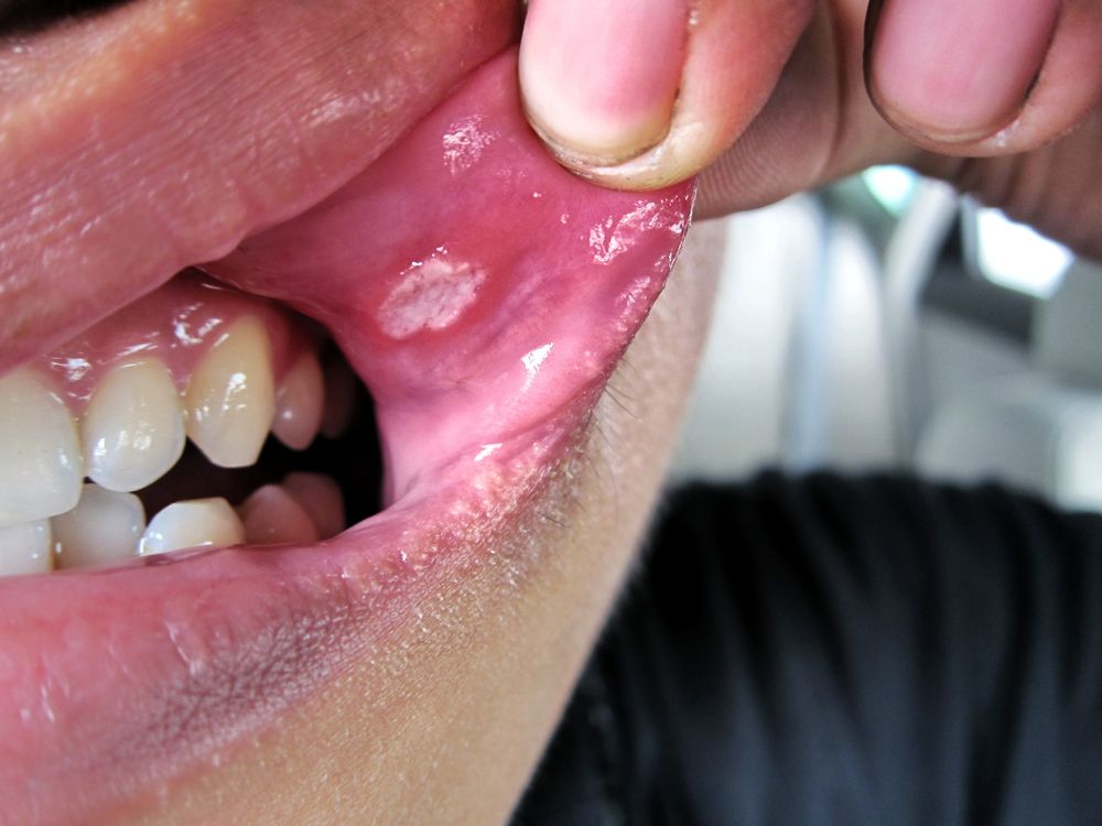 أعراض فطريات الفم واللثة