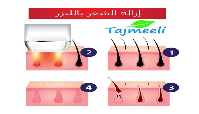 كيف تعمل أجهزة الليزر لإزالة الشعر في مصر؟