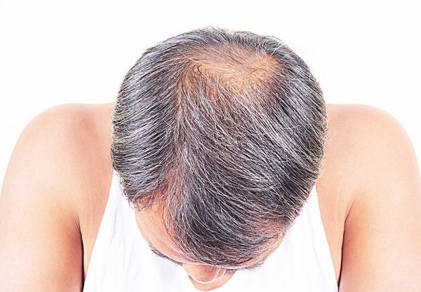 مشكلة الشعر الخفيف عند الرجال والنساء