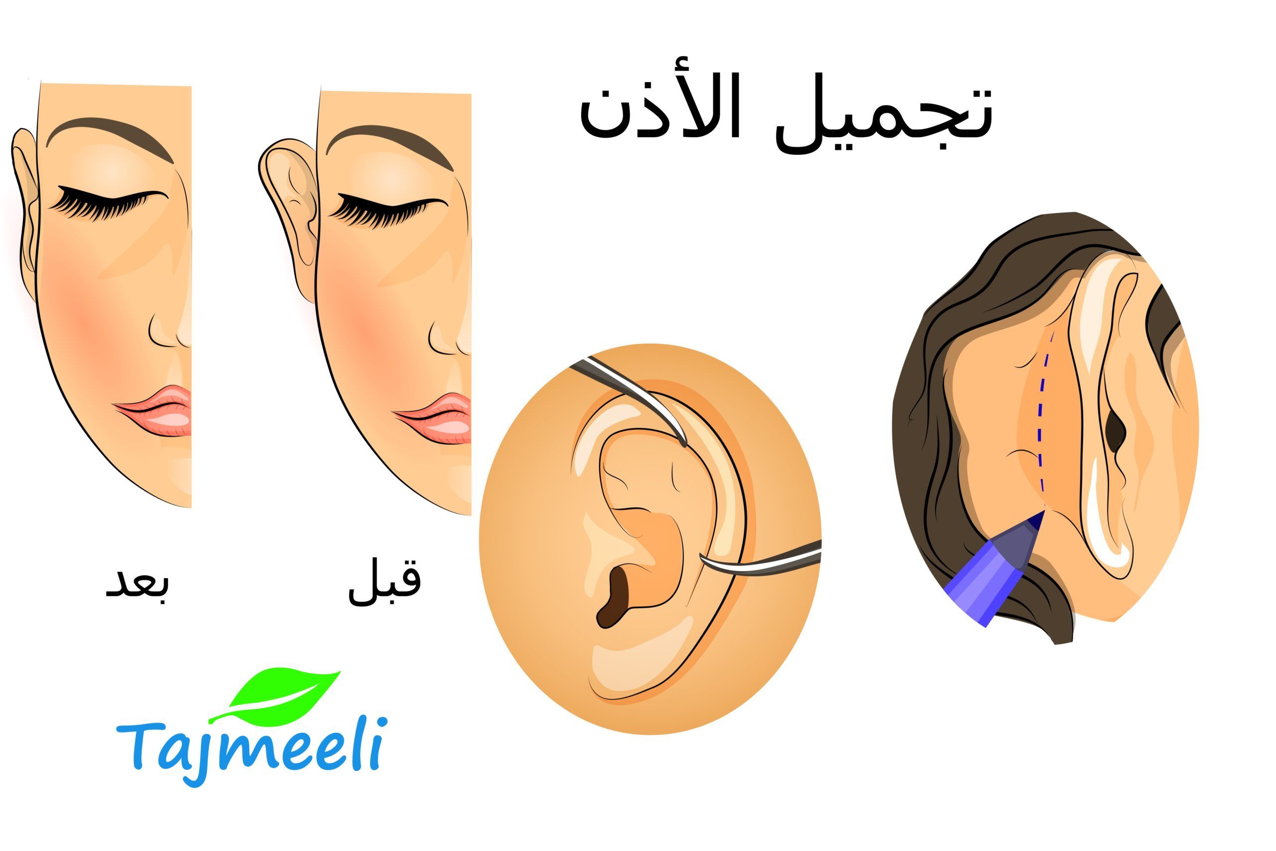 مميزات إجراء عملية تجميل الأذن بالليزر في القاهرة
