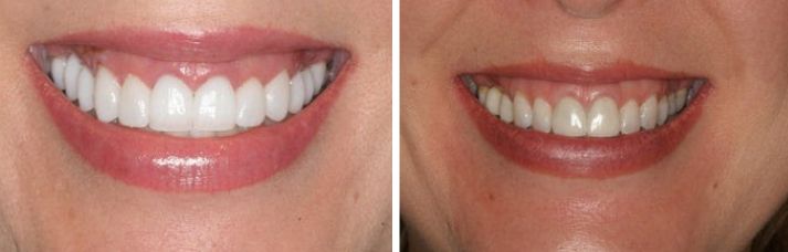 العلاج التجميلي للأسنان Cosmetic Dentistry