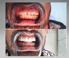 تجميل الأسنان (4)
