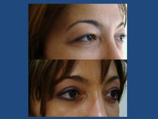 Upper Eyelid Correction 4