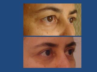 Upper Eyelid Correction 5