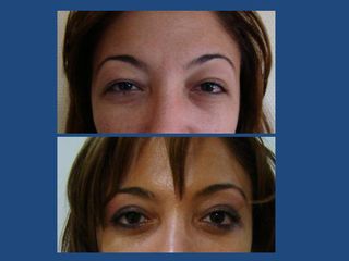 Upper Eyelid Correction 6