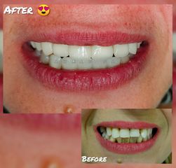 تقويم الأسنان قبل وبعد (2)
