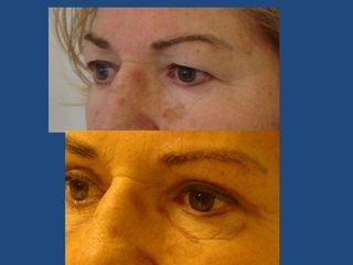 Upper Eyelid Correction 12