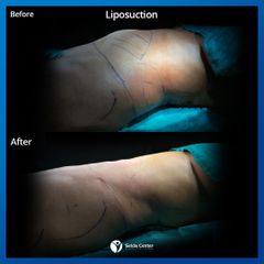 شفط الدهون - مركز الدكتورة سيلدا التخصصي