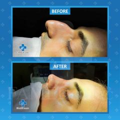 famedclinic rhinoplasty before&afte