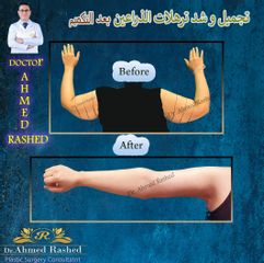 شفط الدهون - الدكتور احمد راشد