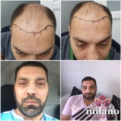 عملية زراعة الشعر قبل وبعد