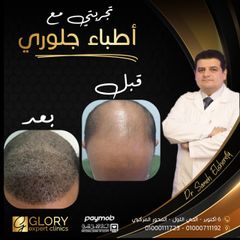 زراعة الشعر (3)