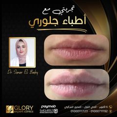 تجميل الشفايف (3)