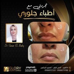 تجميل الشفايف (4)