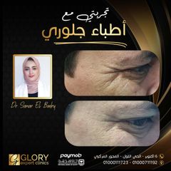 علاج التجاعيد (2)