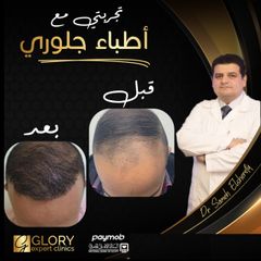 زراعة-الشعر-2