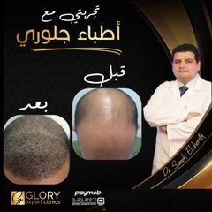 زراعة-الشعر-3