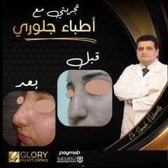 تجميل-الأنف-1