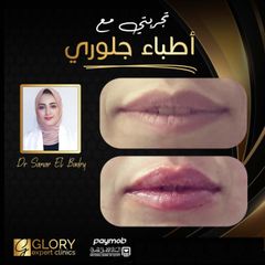 تجميل-الشفايف