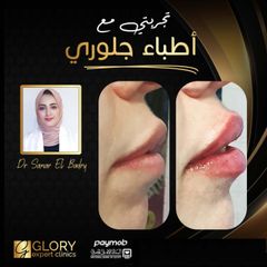 تجميل-الشفايف-2