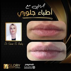 تجميل-الشفايف-3