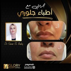 تجميل-الشفايف-4