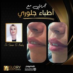 تجميل-الشفايف-5