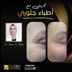 علاج-التجاعيد