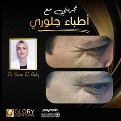 علاج-التجاعيد-2