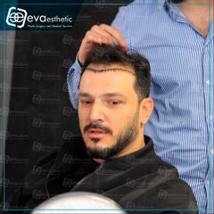 مدة زراعة الشعر في تركيا