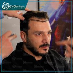 زراعة الشعر في تركيا للرجال