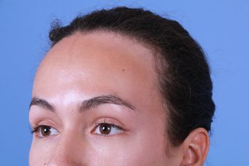 Forehead reduction Before