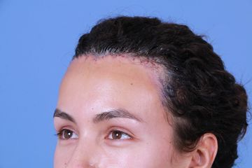 Forehead reduction 1 week post op