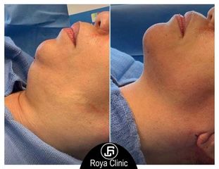  double chin removal