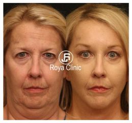 face and neck lift - Ingland