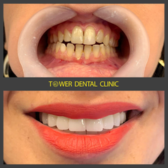 zirconia crowns