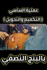 عملية تكميم المعدة - مركز د. محمد الزيتاوي
